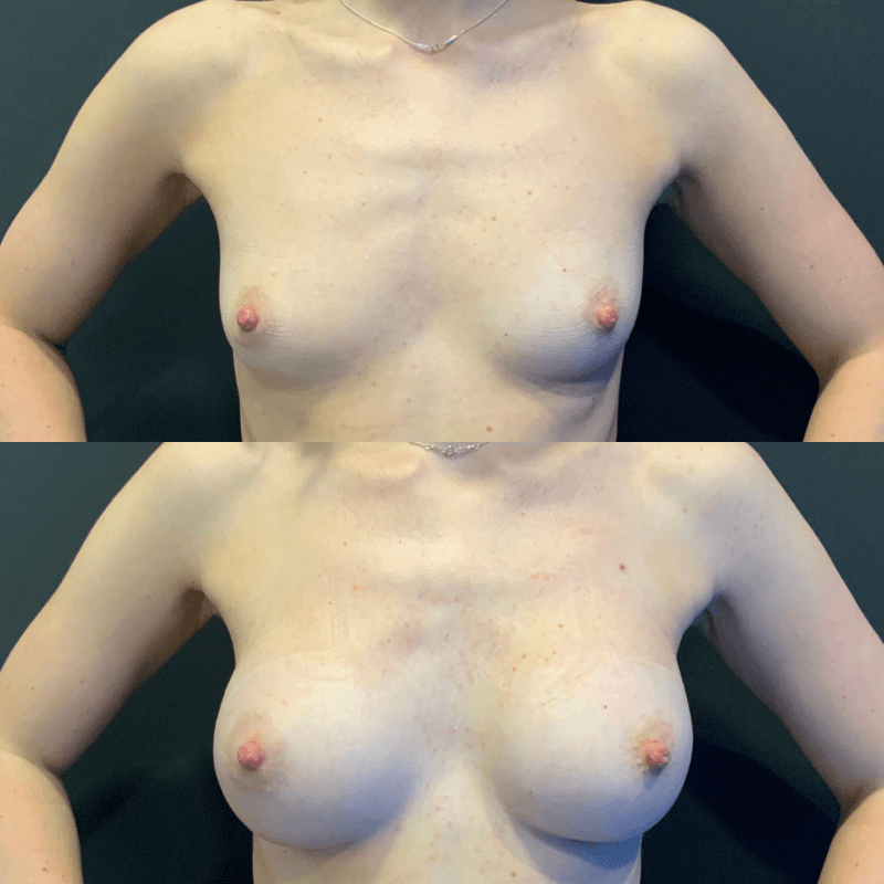 Breast Augmentation - Before and After