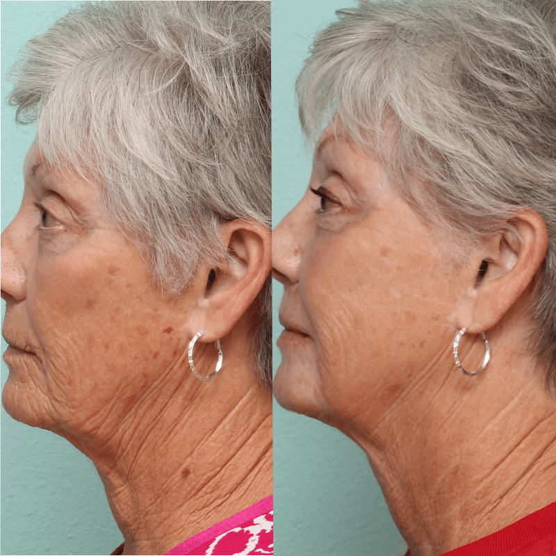 Laser Skin Resurfacing - Before and After