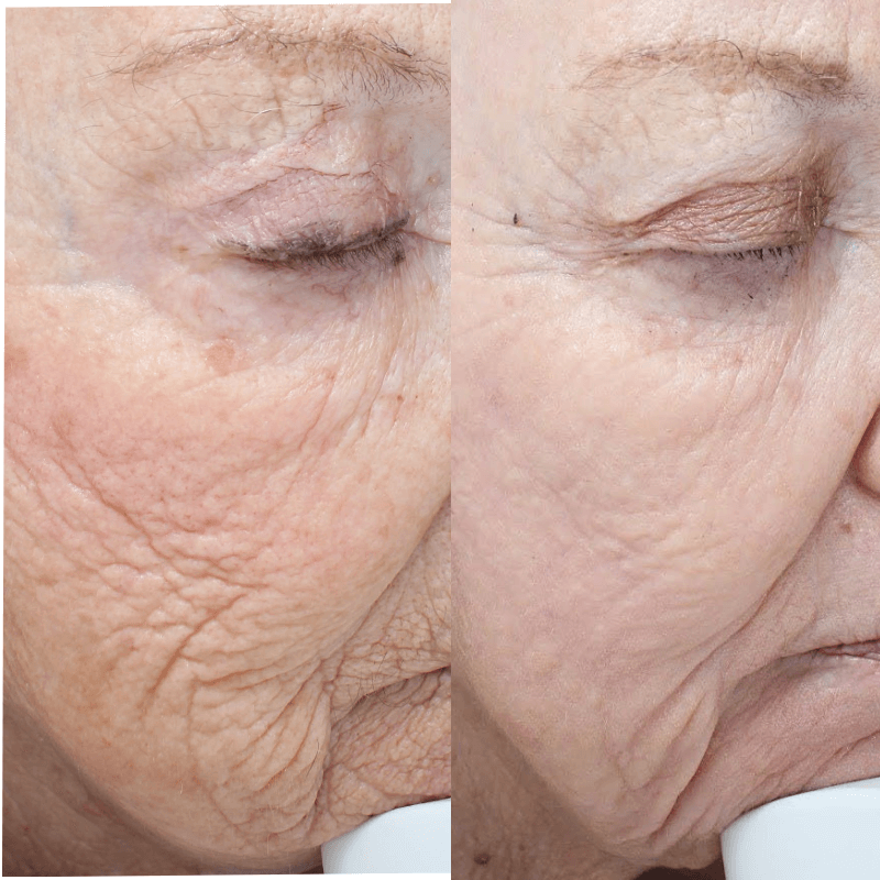 Laser Skin Resurfacing - Before and After