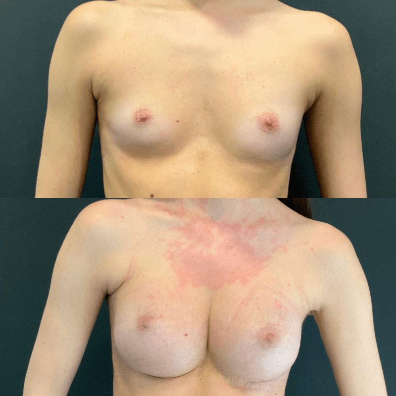 Breast Augmentation - Before and After
