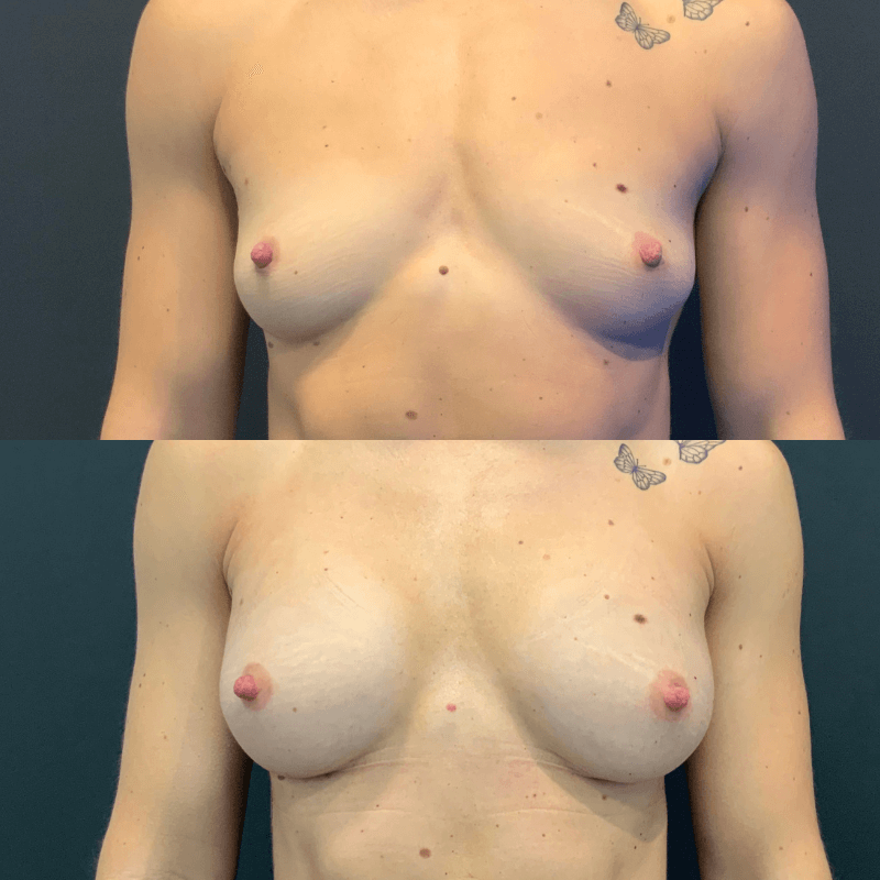 Breast Augmentation - Before and After