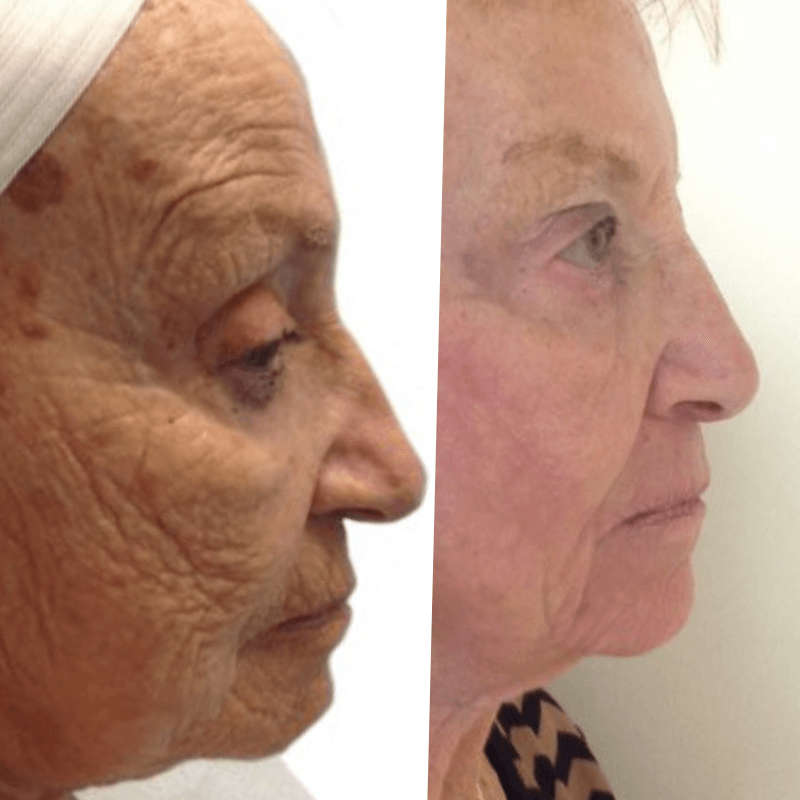 Laser Skin Resurfacing - Before and After