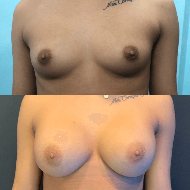 Breast Augmentation - Before and After