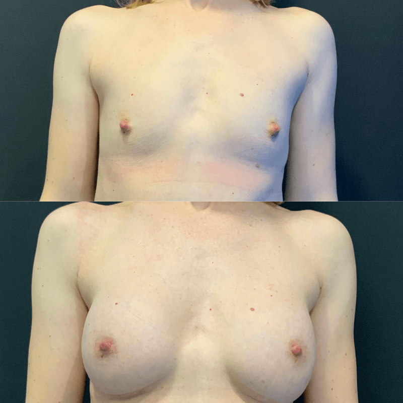 Breast Augmentation - Before and After