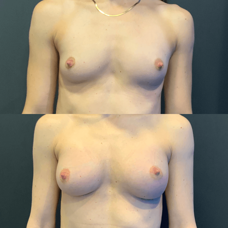 Breast Augmentation - Before and After