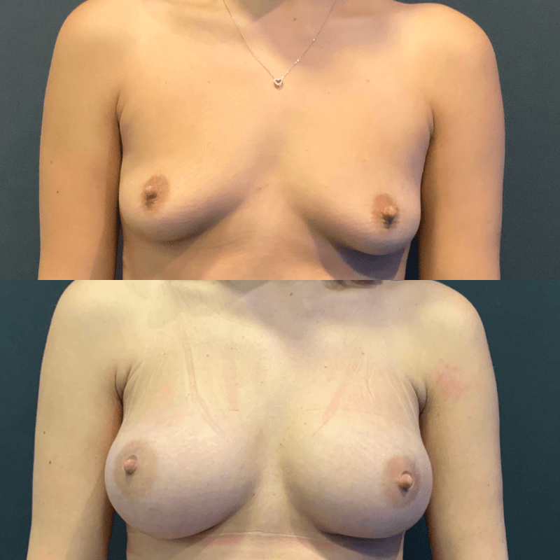 Breast Augmentation - Before and After