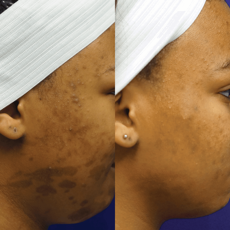 Laser Skin Resurfacing - Before and After