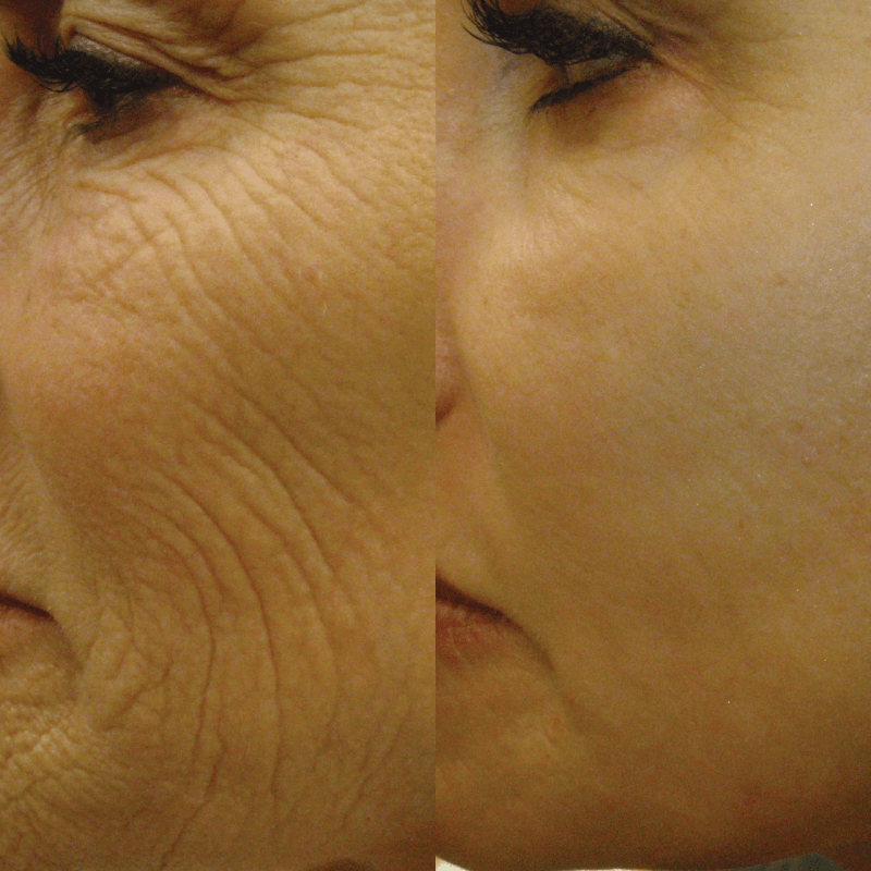 Laser Skin Resurfacing - Before and After