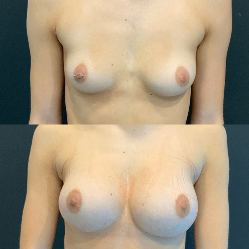 Breast Augmentation - Before and After
