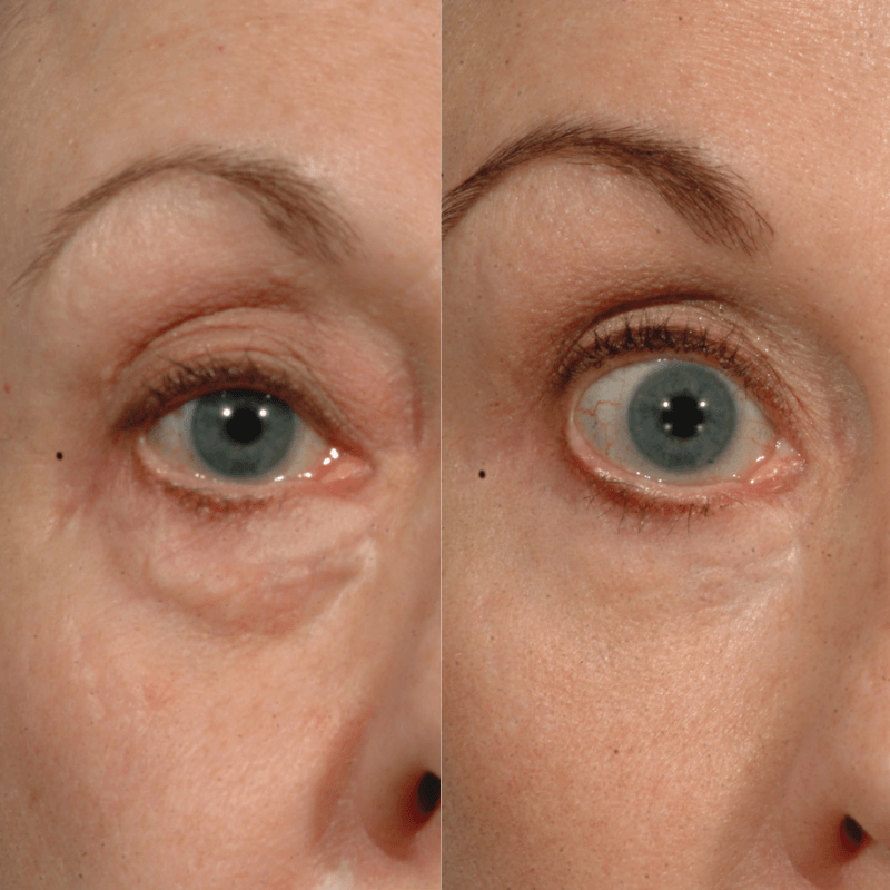Laser Skin Resurfacing - Before and After