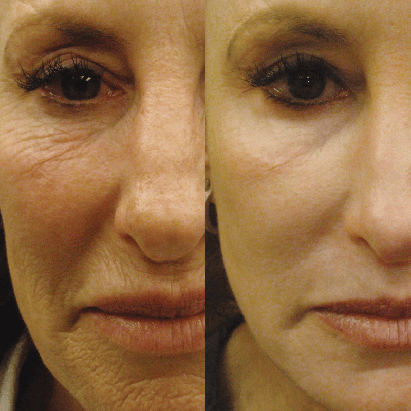 Laser Skin Resurfacing - Before and After