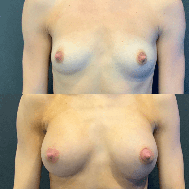 Breast Augmentation - Before and After