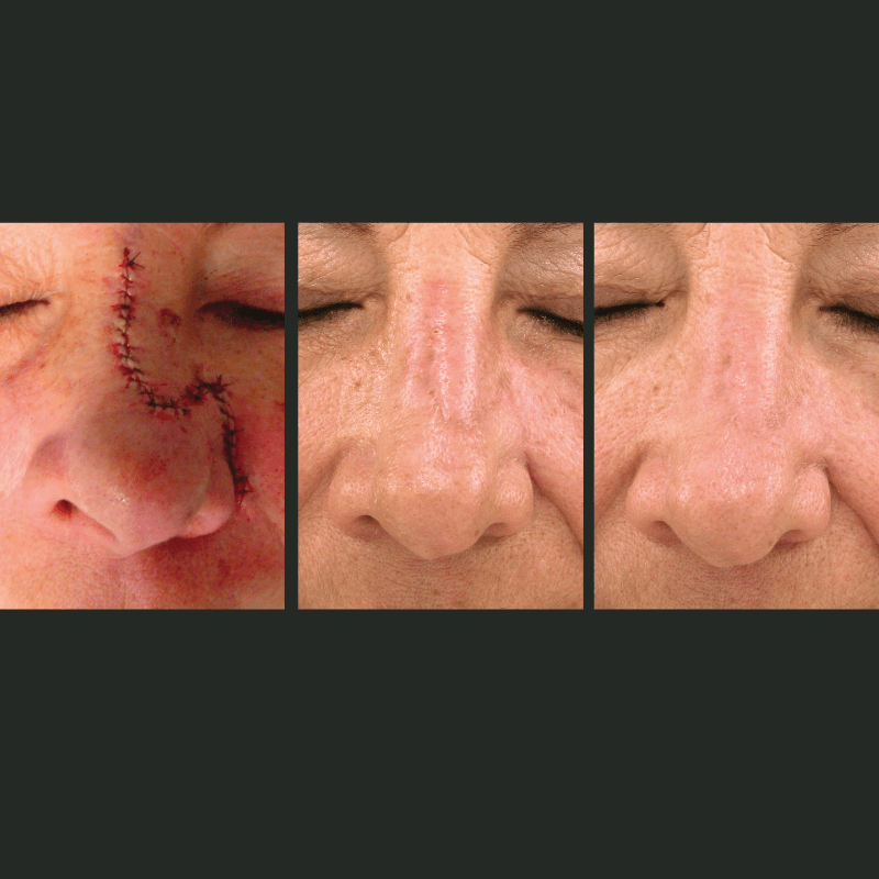 Laser Skin Resurfacing - Before and After