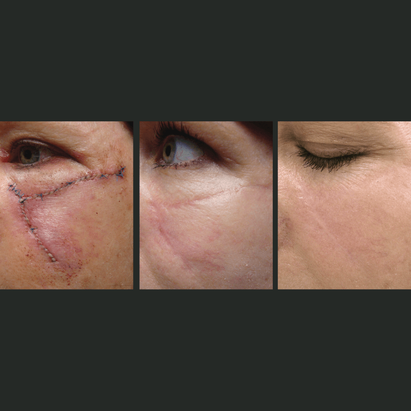 Laser Skin Resurfacing - Before and After