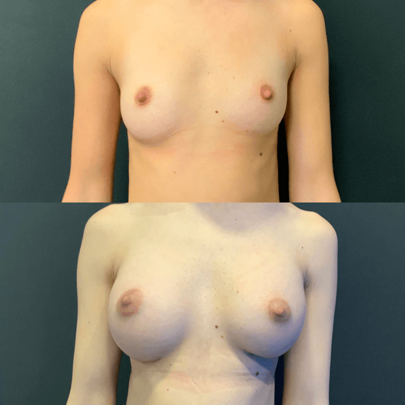Breast Augmentation - Before and After