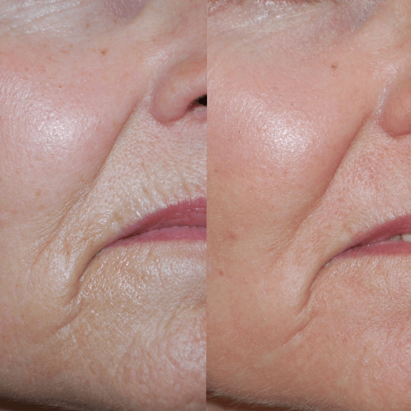 Laser Skin Resurfacing - Before and After