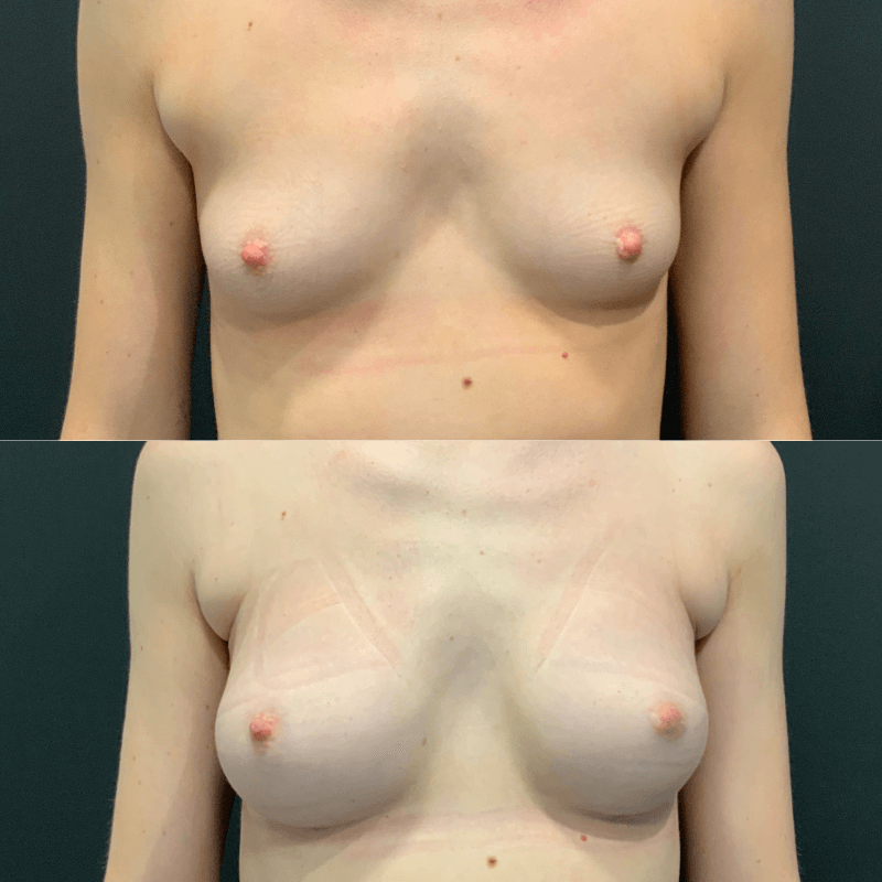 Breast Augmentation - Before and After