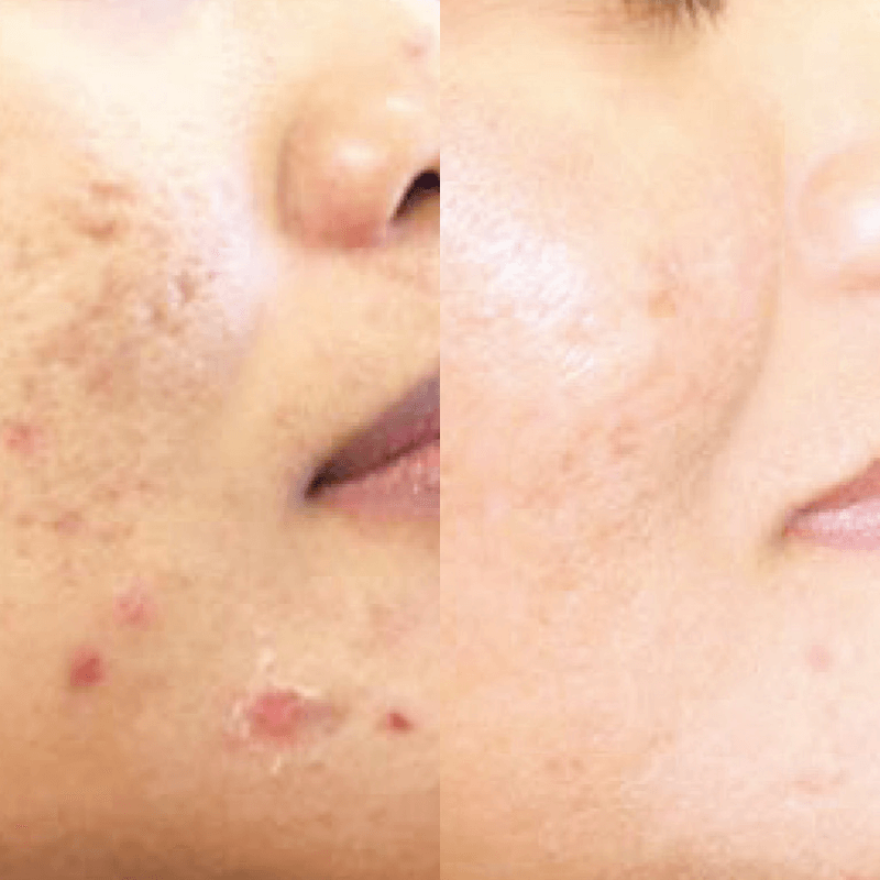 Laser Skin Resurfacing - Before and After