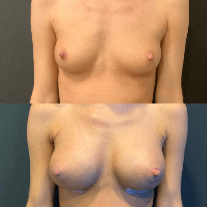 Breast Augmentation - Before and After