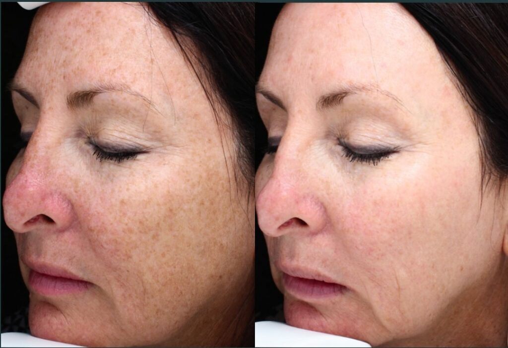 How Does Halo Laser Work