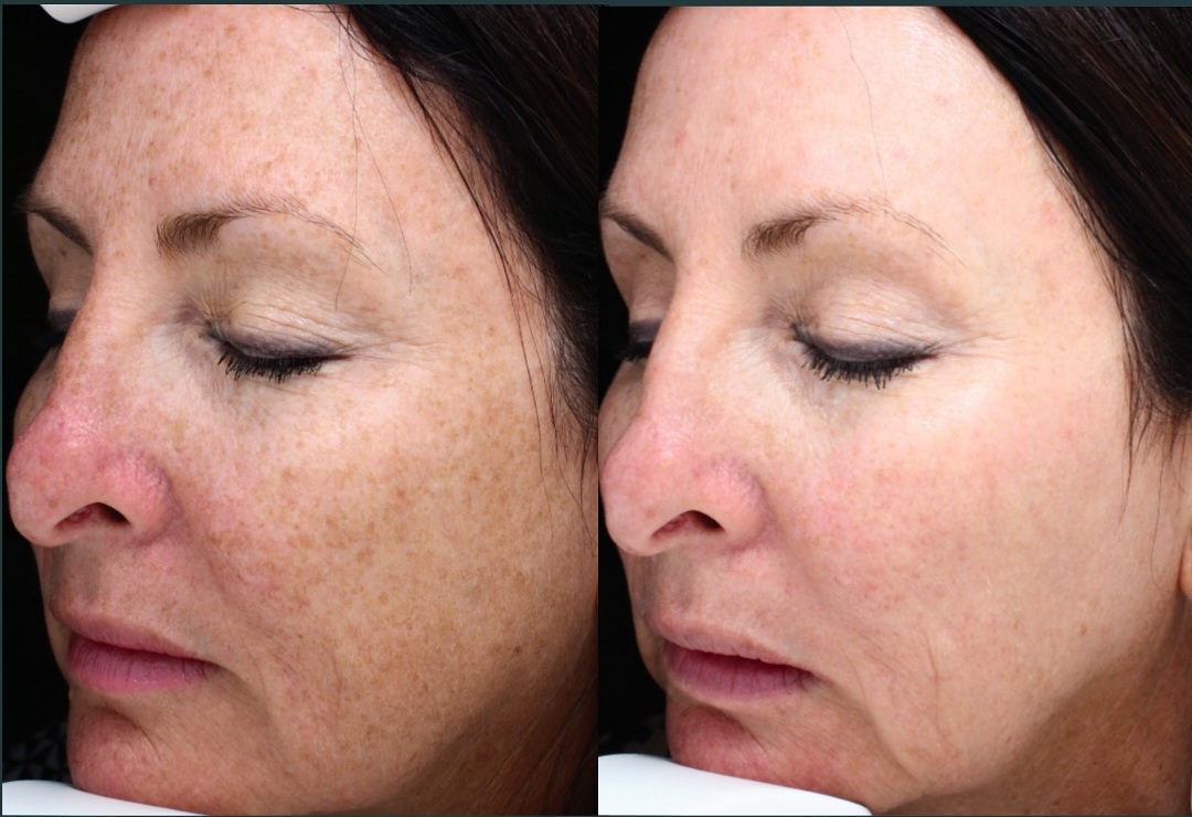 How Does Halo Laser Work