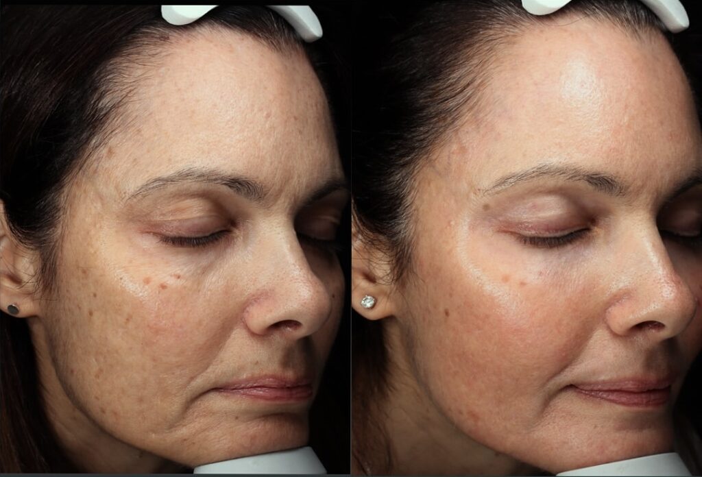 What’s The Best Type of Laser To Remove Pigmentation